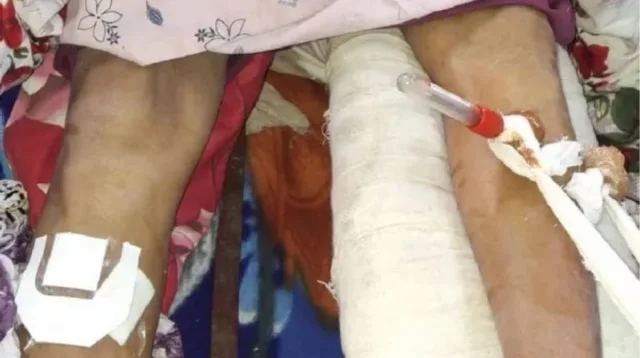 বাঁ পায়ের হাড় ভেঙে যাওয়া রোগীর ডান পায়ে অপারেশন করলো ডাক্তার!